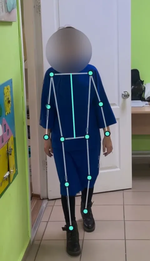 The same patient after 7 sessions walking on her own without a cane